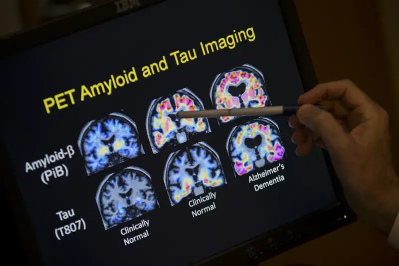Lowering Your Risk Of Dementia Doesn't Necessarily Involve A Blood Test